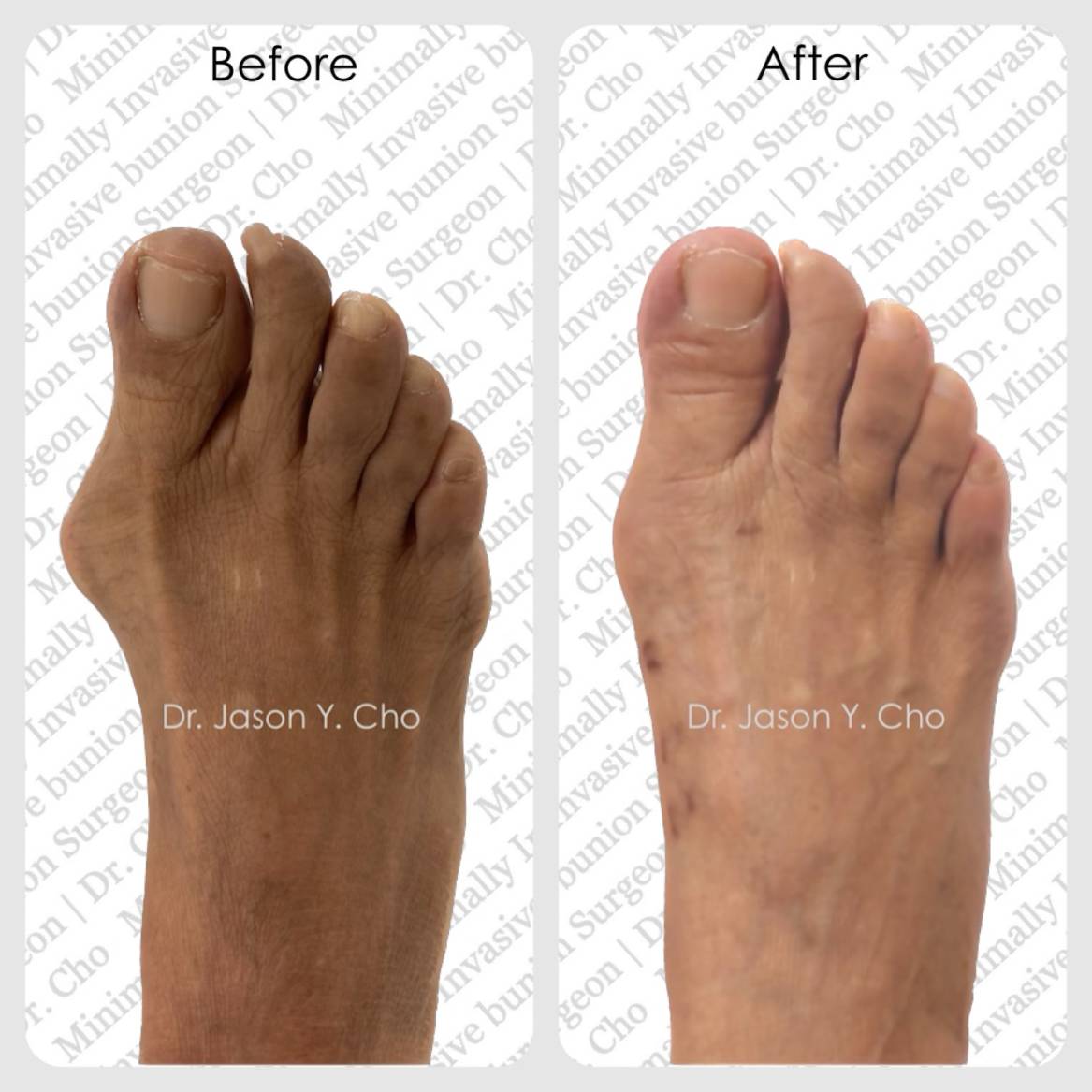 Minimally invasive bunion surgery nyc