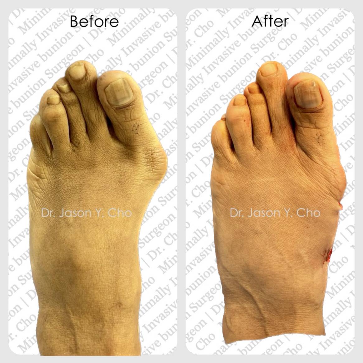 Minimally invasive bunion surgery nyc
