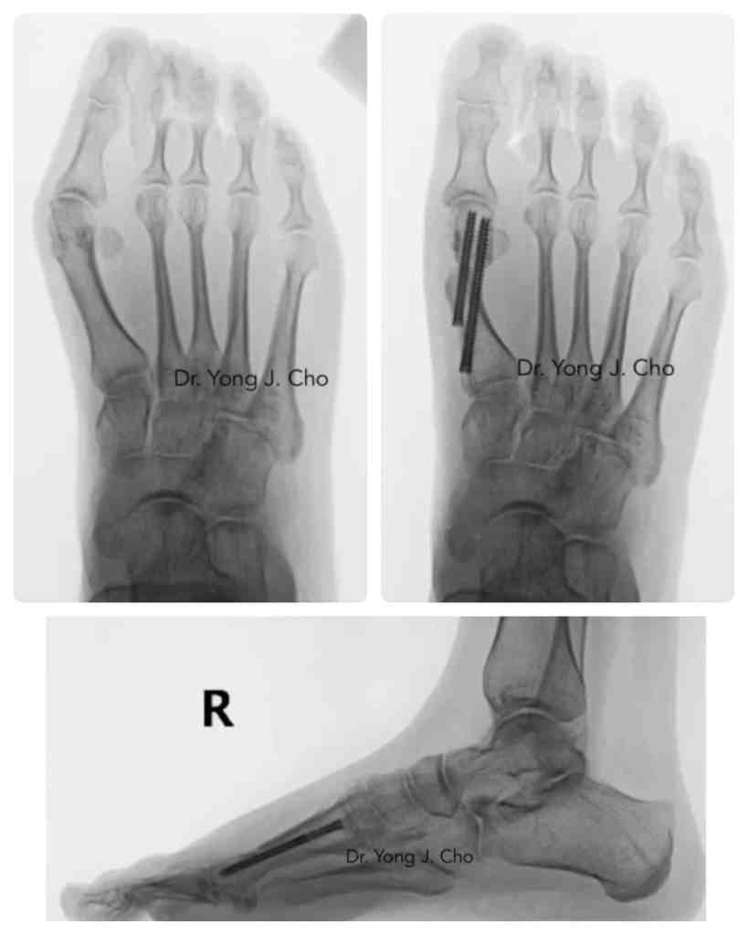 Minimally invasive bunion surgery before and after xray X-ray

