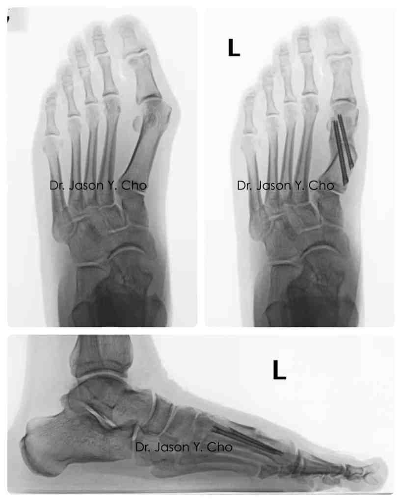 Minimally invasive bunion surgery before and after xray X-ray
