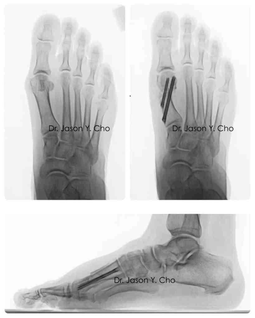 Minimally invasive bunion surgery before and after xray X-ray
