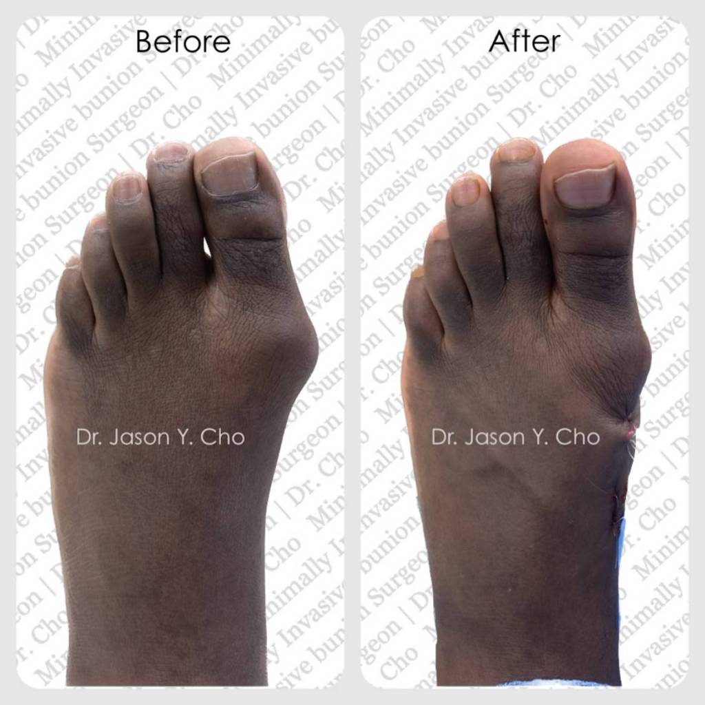 Minimally invasive bunion surgery. Before and after picture photo nyc