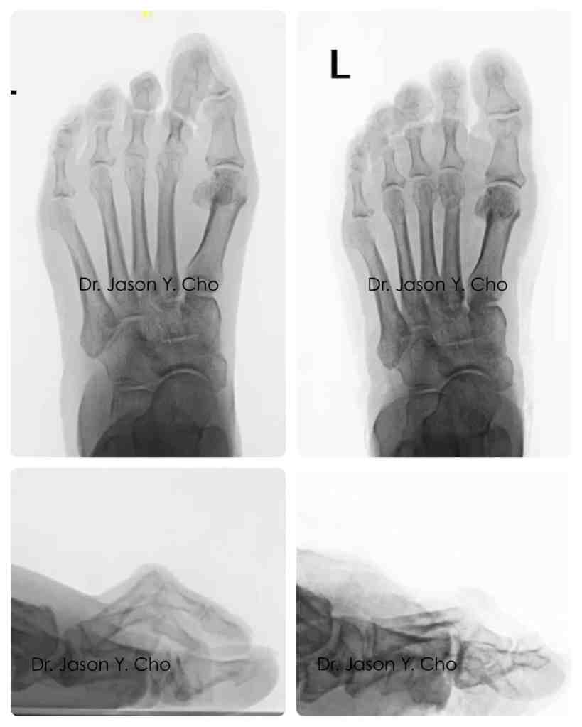 Minimally invasive hammertoe surgery before and after xray X-ray
