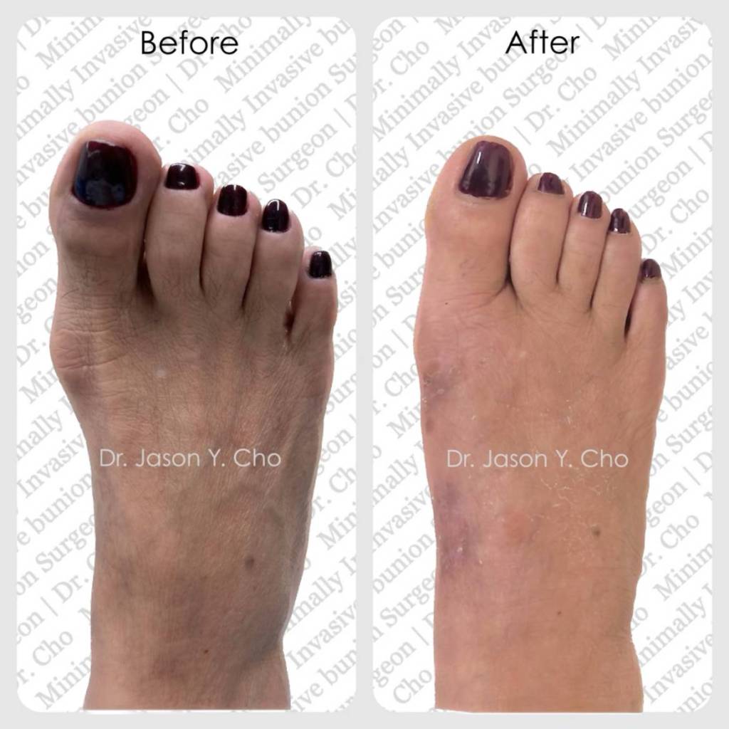Minimally invasive bunion surgery. Before and after picture photo nyc