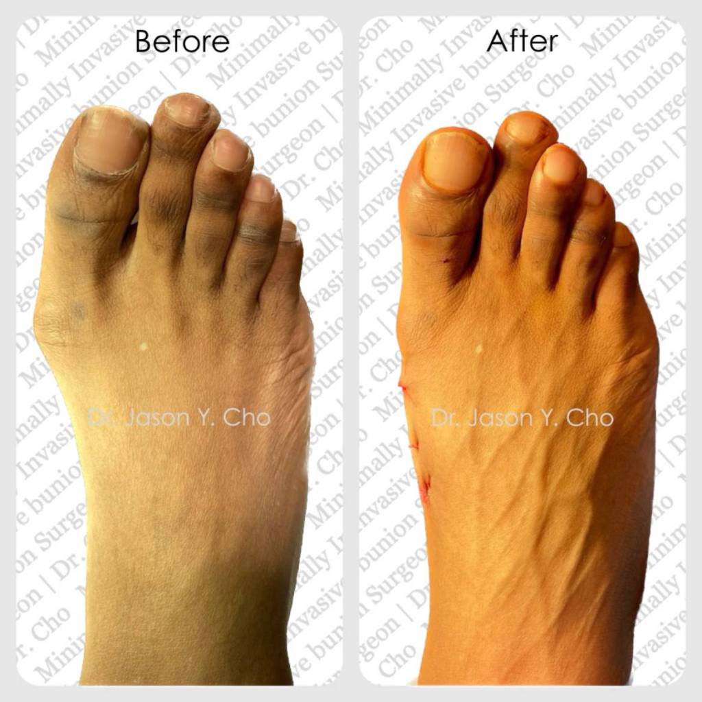 Minimally invasive bunion surgery. Before and after picture photo nyc