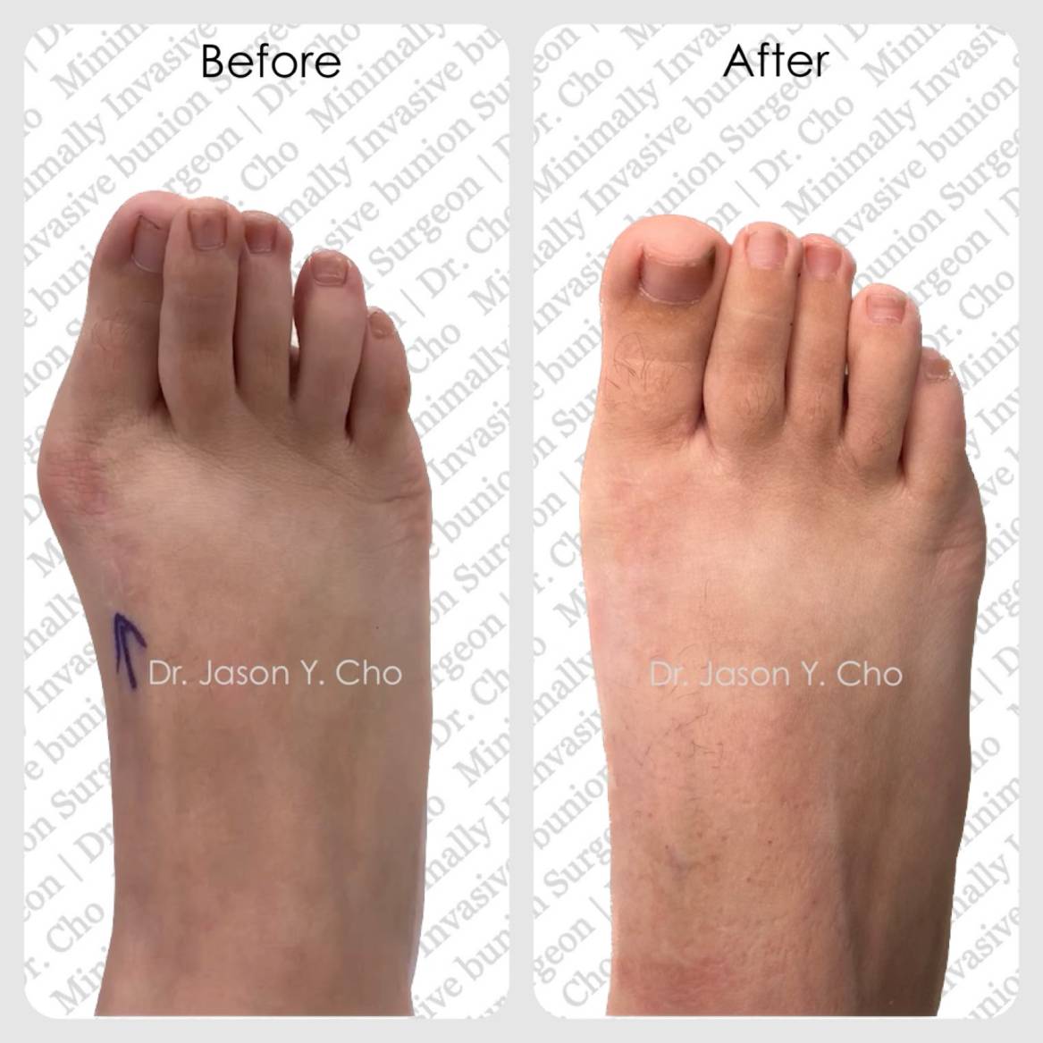 Minimally invasive bunion surgery nyc