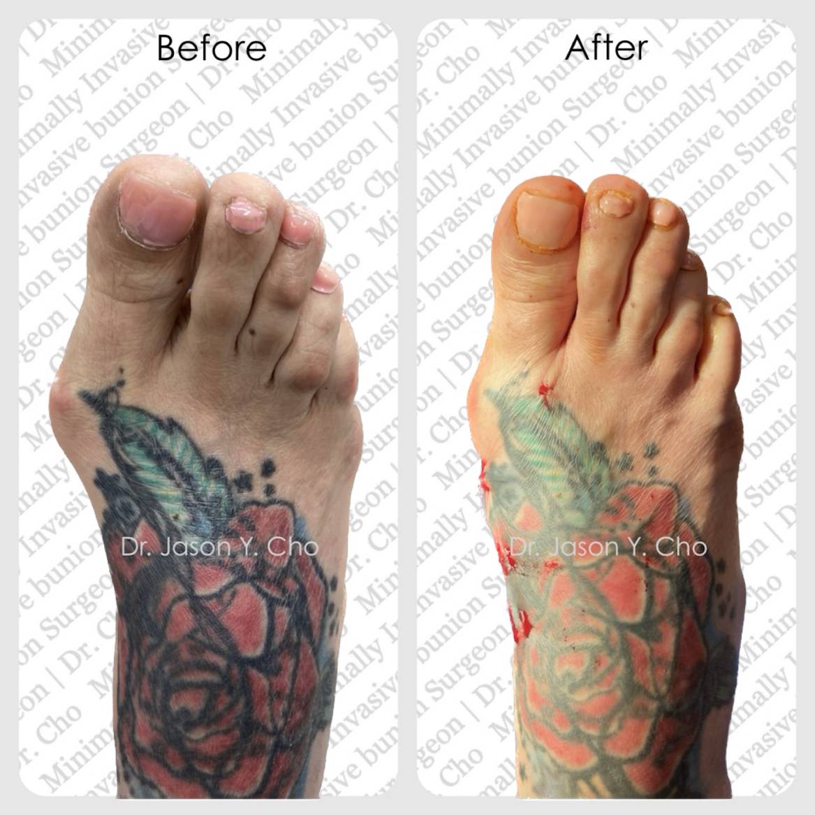 Minimally invasive bunion surgery nyc