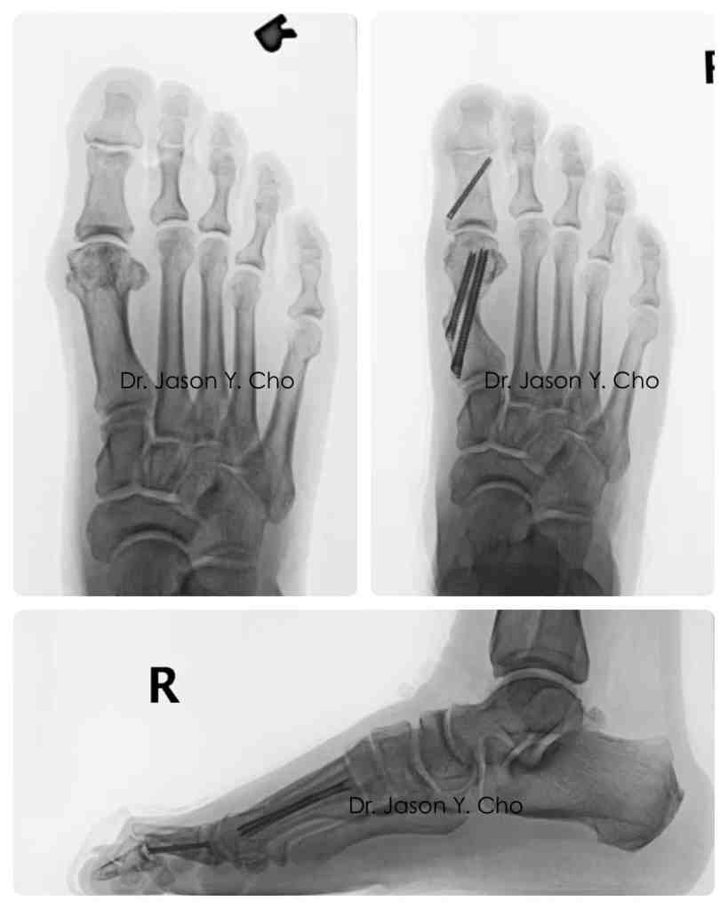 Minimally invasive bunion surgery before and after xray X-ray

