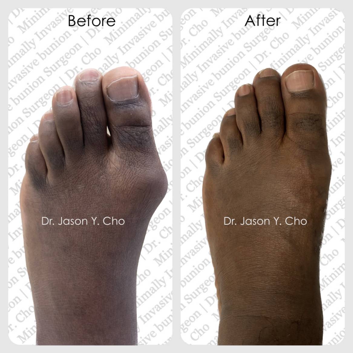 Minimally invasive bunion surgery. Before and after picture photo nyc