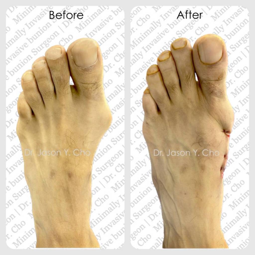 Minimally invasive bunion surgery. Before and after picture photo nyc