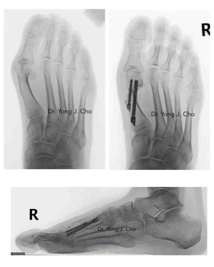 Minimally invasive bunion surgery before and after xray X-ray

