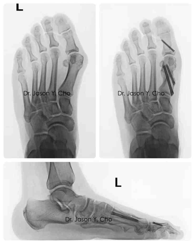 Minimally invasive bunion surgery before and after xray X-ray
