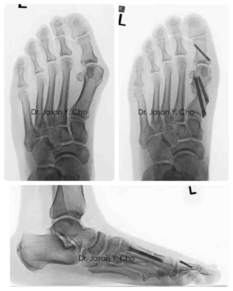 Minimally invasive bunion surgery before and after xray X-ray
