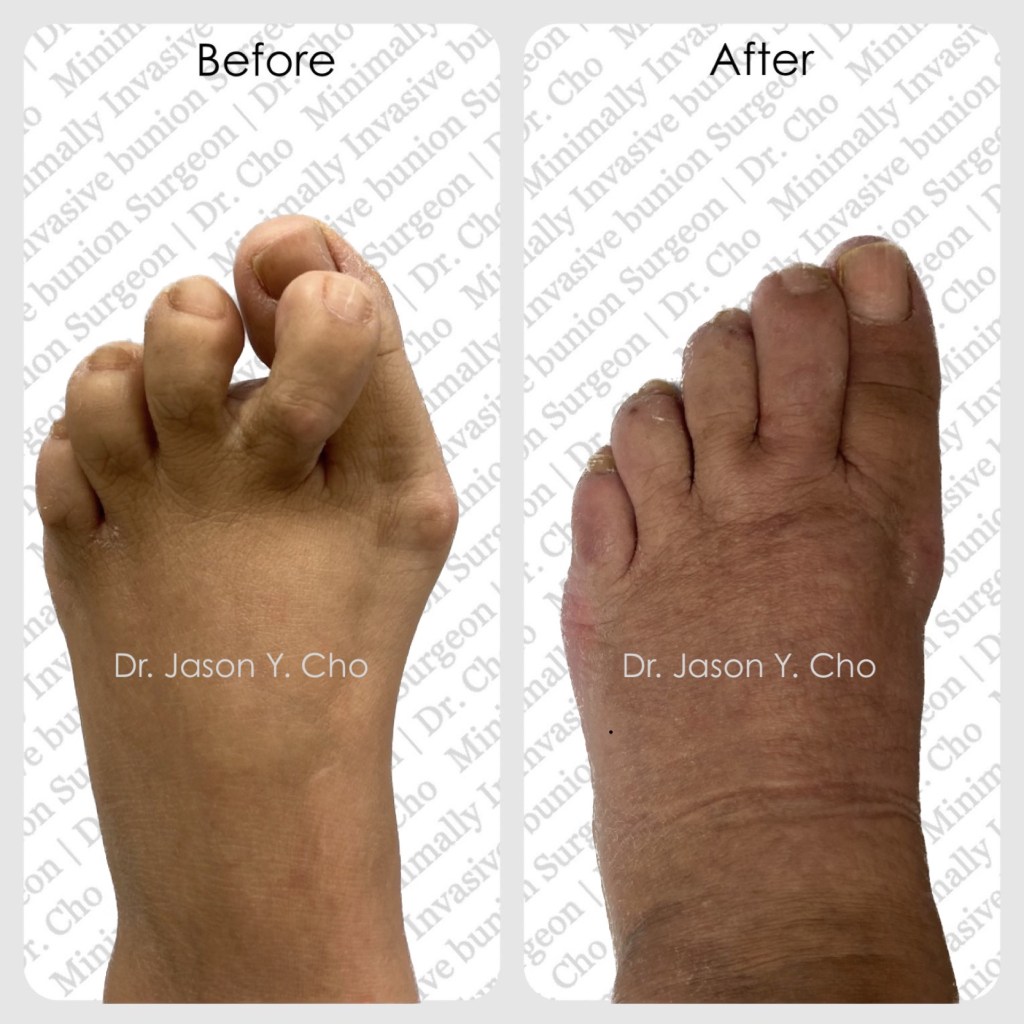 Minimally invasive bunion surgery. Before and after picture photo nyc