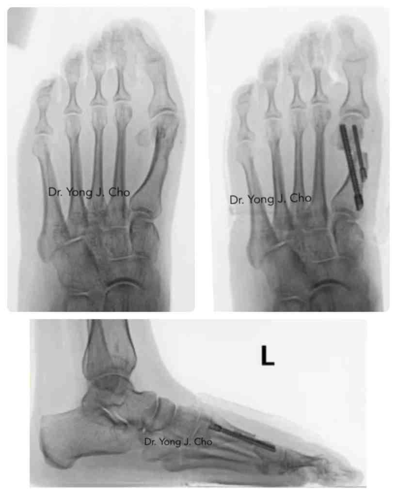 Minimally invasive bunion surgery before and after xray X-ray

