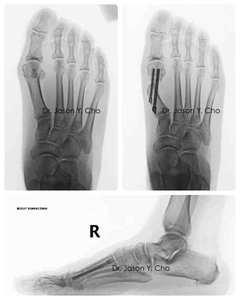 Minimally invasive bunion surgery before and after xray X-ray

