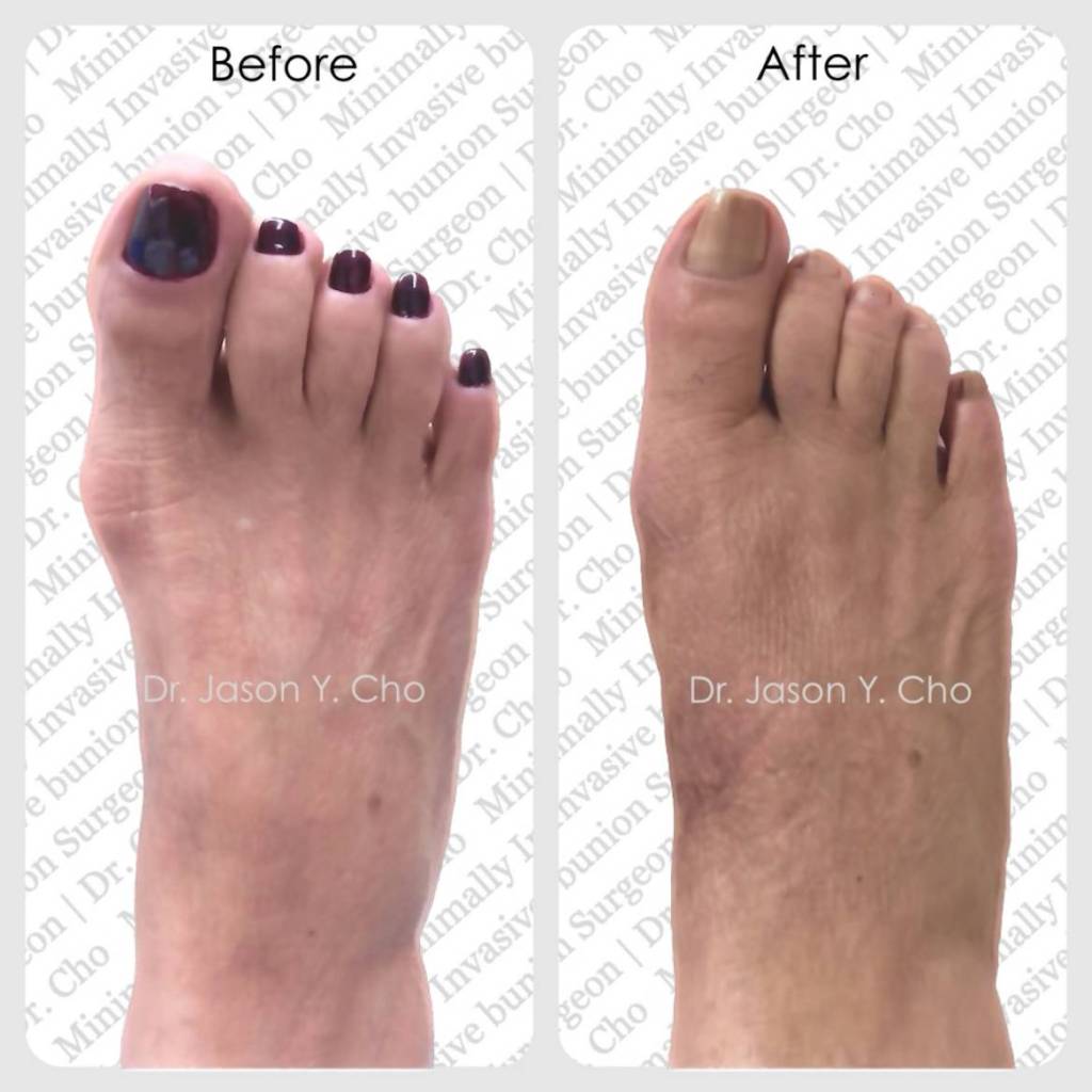 Minimally invasive bunion surgery. Before and after picture photo nyc