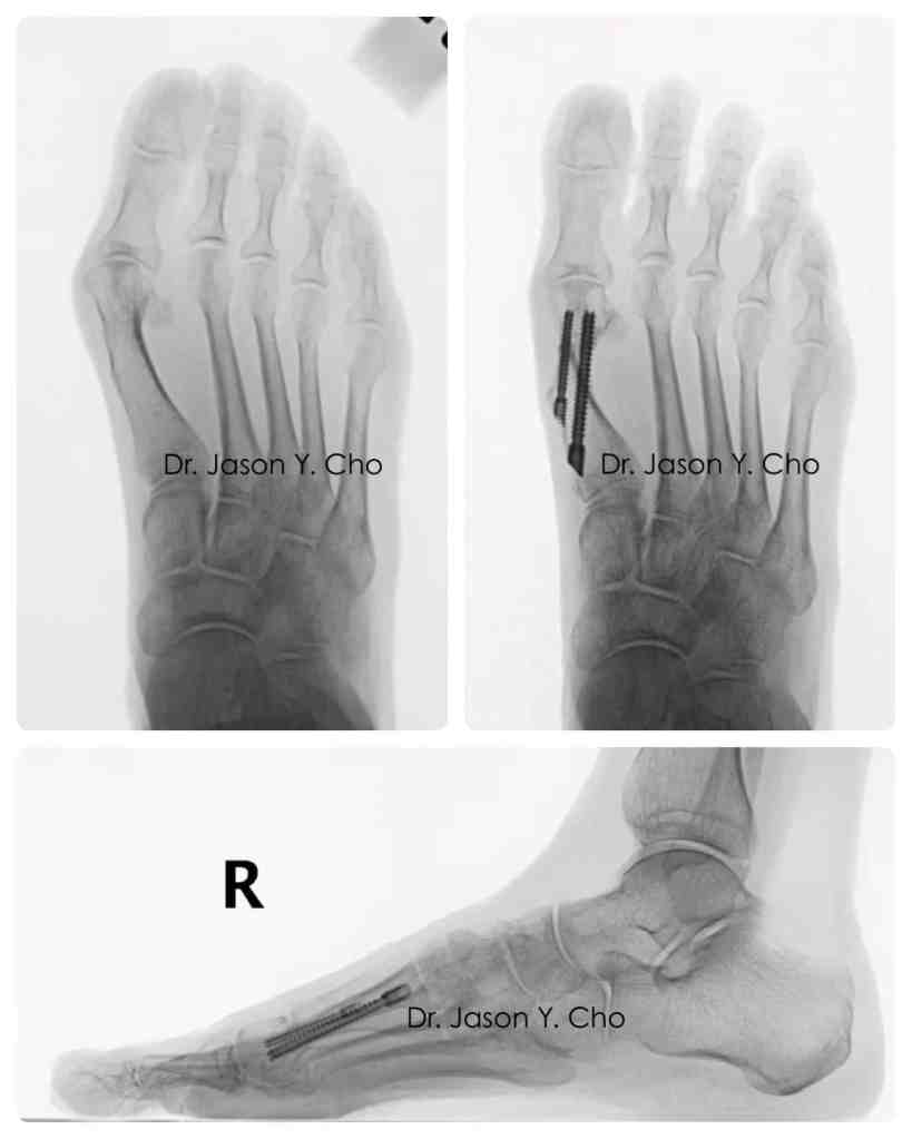 Minimally invasive bunion surgery before and after xray X-ray

