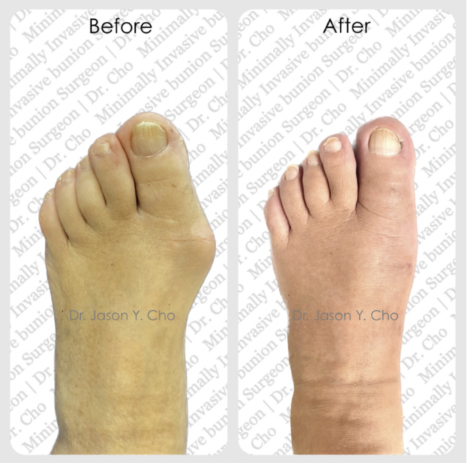 Minimally invasive bunion surgery nyc