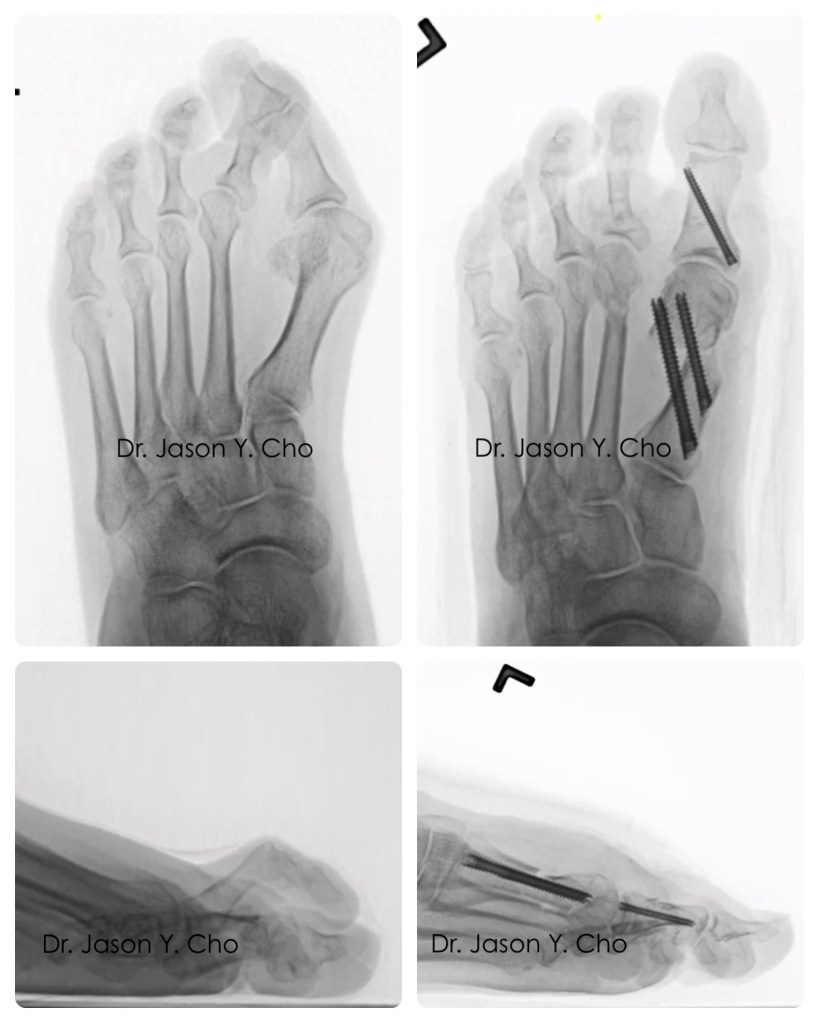 Minimally invasive bunion surgery before and after xray X-ray
