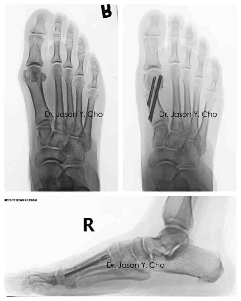 Minimally invasive bunion surgery before and after xray X-ray


