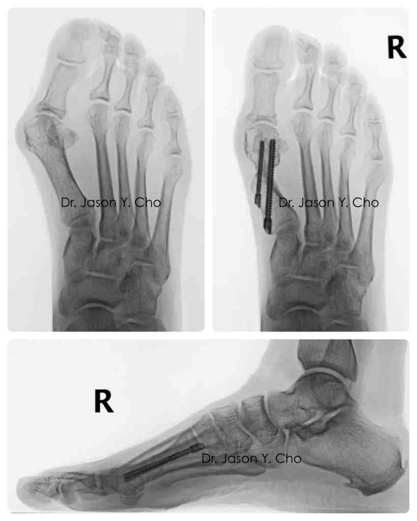 Minimally invasive bunion surgery before and after xray X-ray
