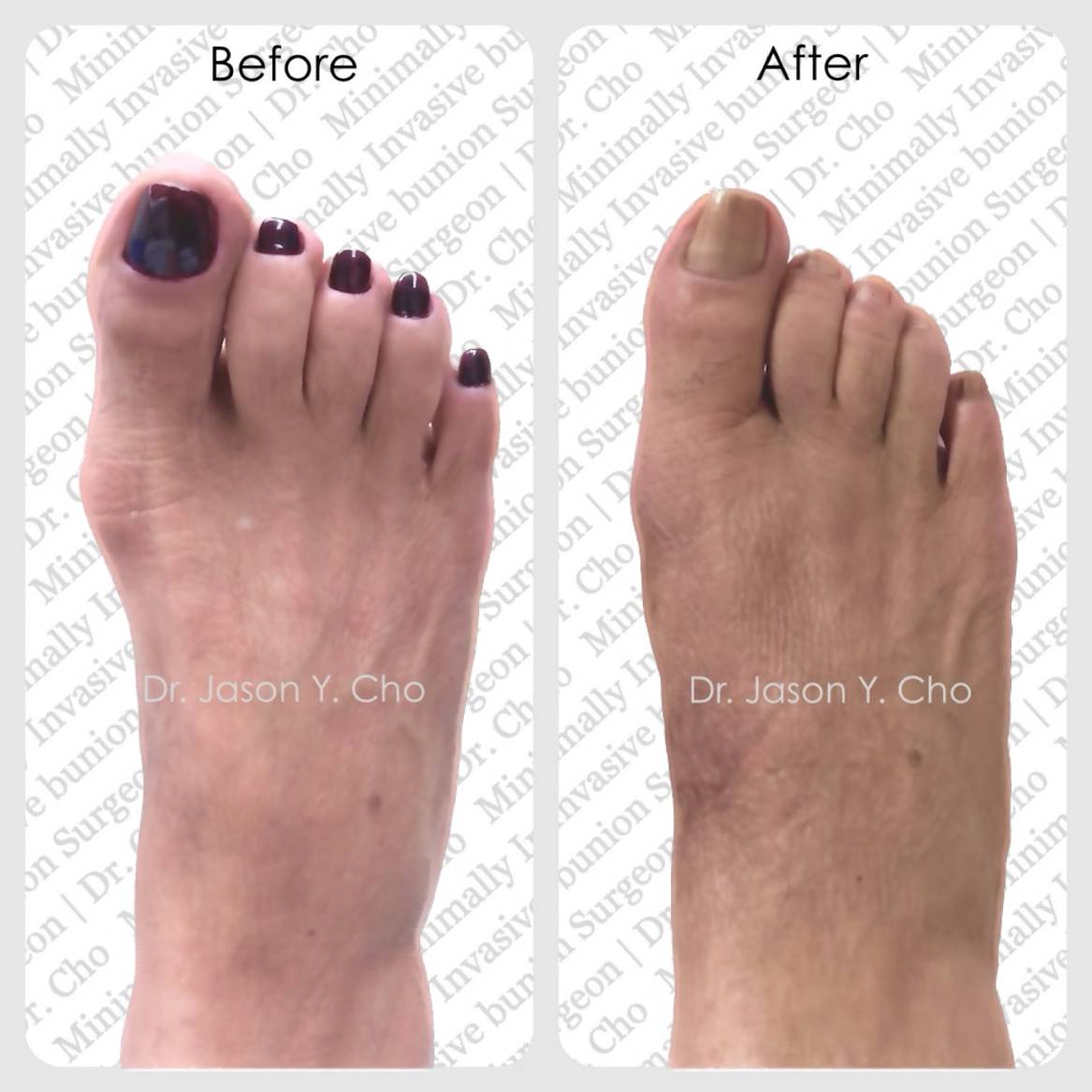 Minimally invasive bunion surgery nyc