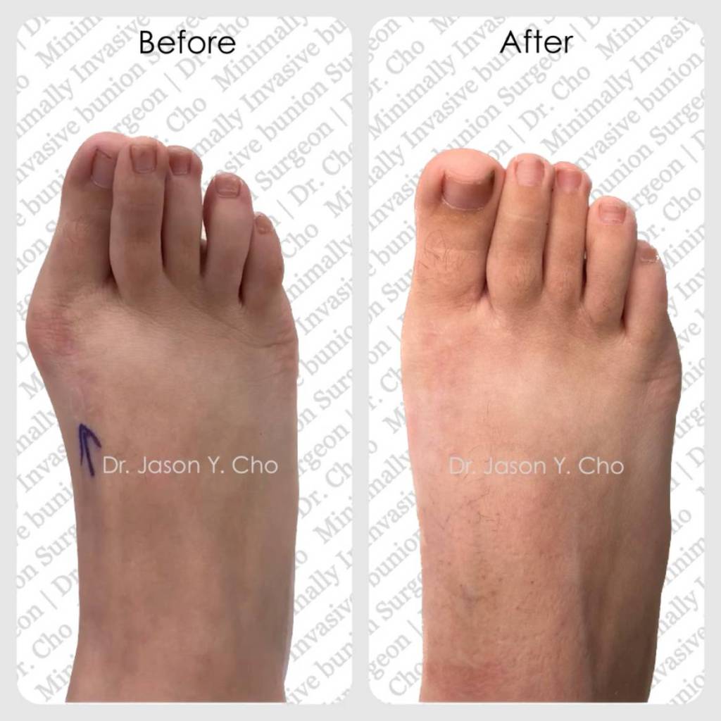 Minimally invasive bunion surgery. Before and after picture photo nyc